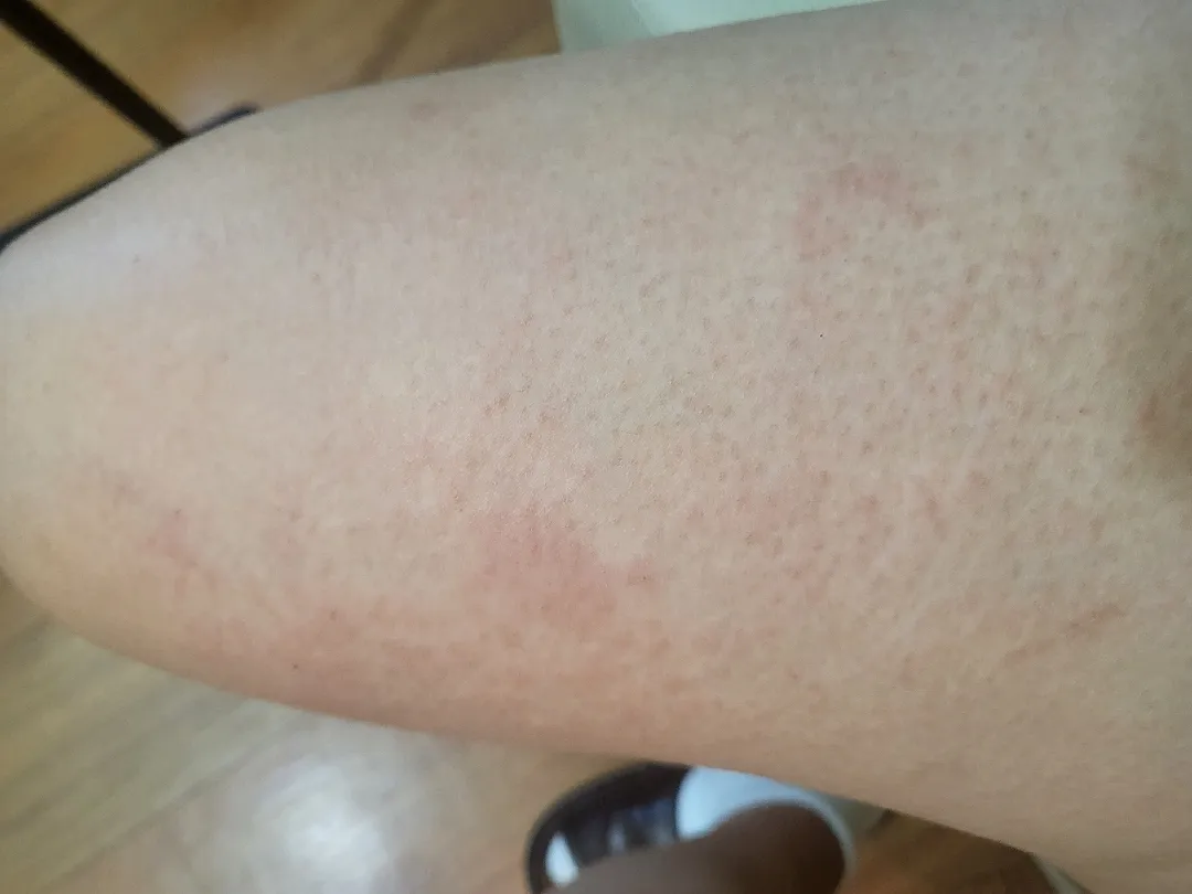 몸이 간지러워요 ㅠ