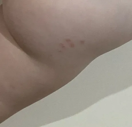 아기피부 붉은반점??