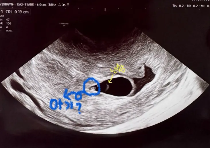 6주인데 아기크기 저정도면 괜찮나여..?
