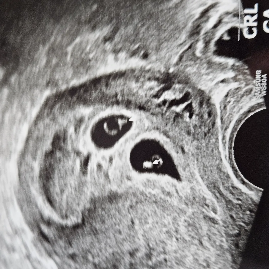 다이아몬드 반지 두개👶👶🤍