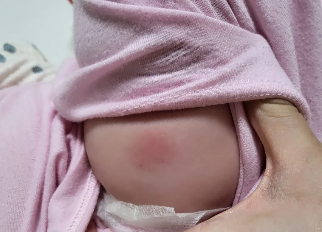 4개월 접종후 몽우리