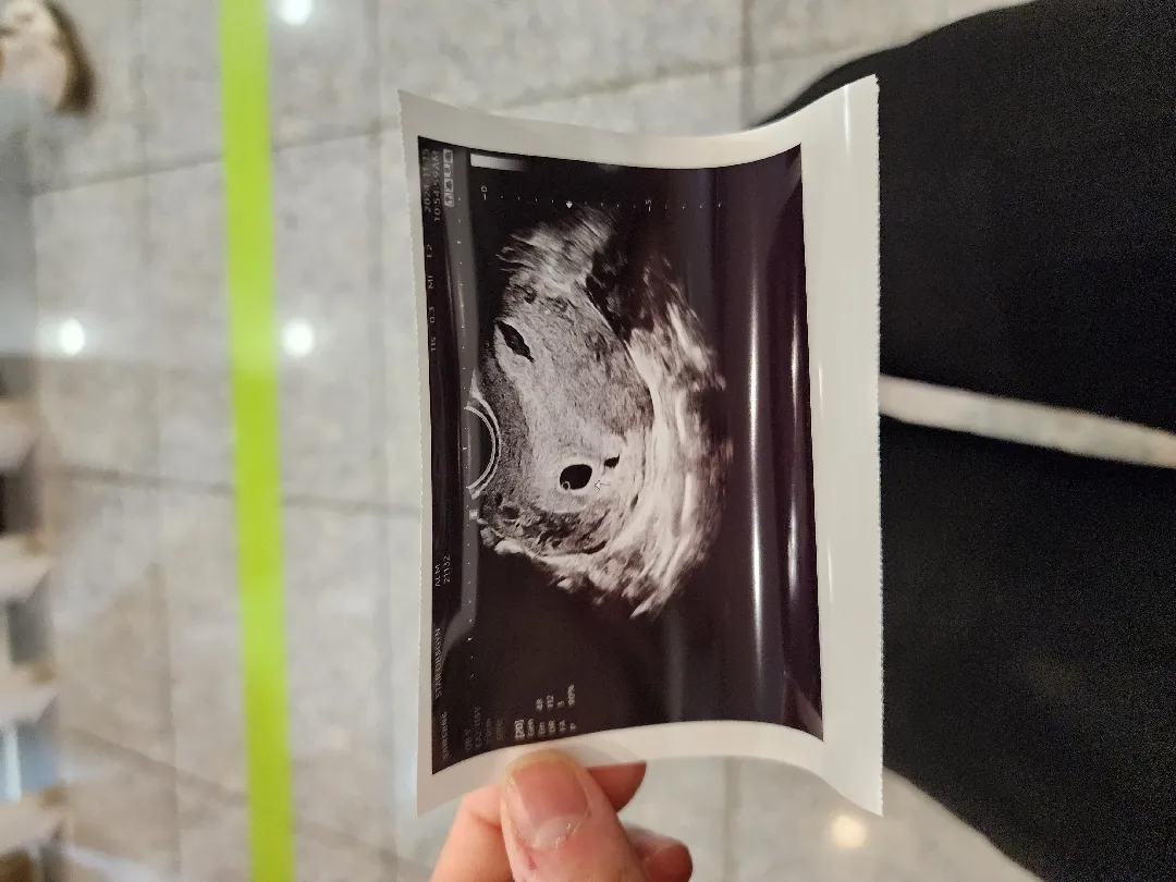 아기집이 많이 작대서 걱정