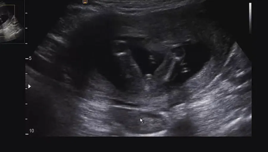 16주 아들? 딸?