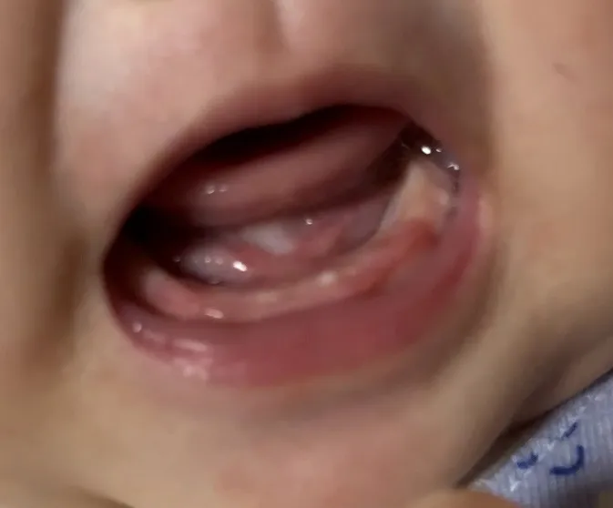 110일째에 이가 확연하게 올라왔어요🤣
