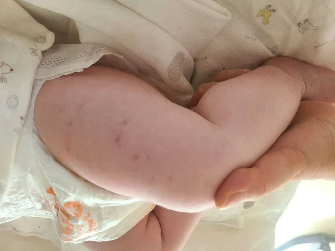 4개월접종 후에 혹시 다리에 반점같은거 생긴 아기있나요??