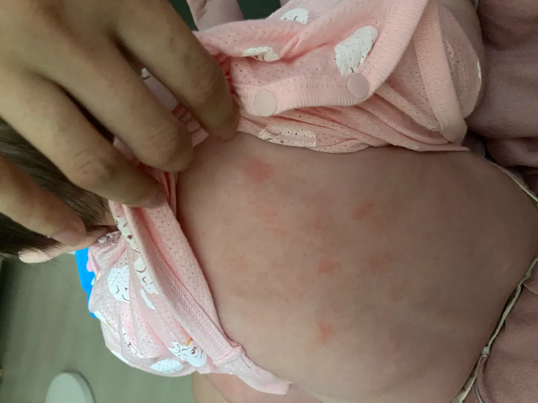 땀띠 맞나요?ㅠㅠ