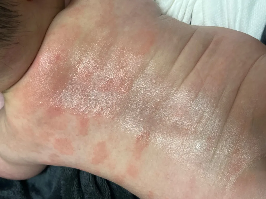 피부 증상 좀 봐주세요 ㅠ
