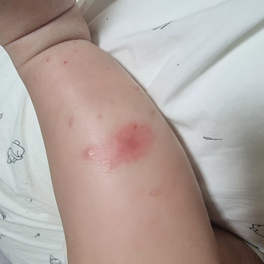 모기?진드기? ㅠ없애고싶어요.