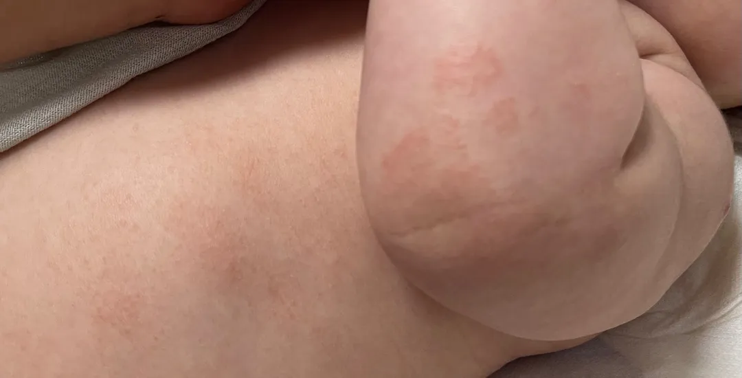 아토피 증상일까요??ㅠ(사진첨부)