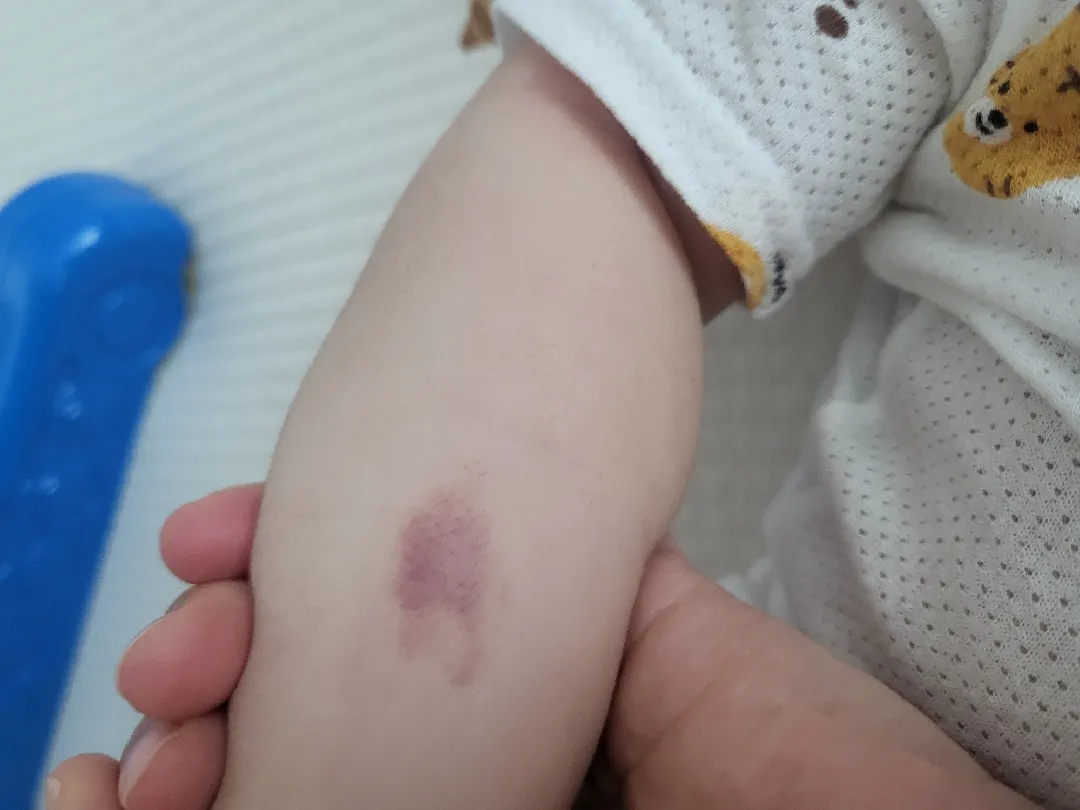 아기 멍ㅠㅠ이렇게 둬도 될까요?