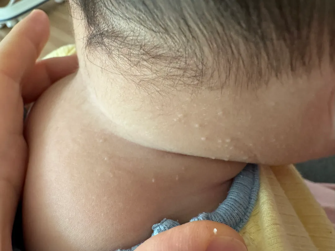 땀띠가 맞을까요?🥺