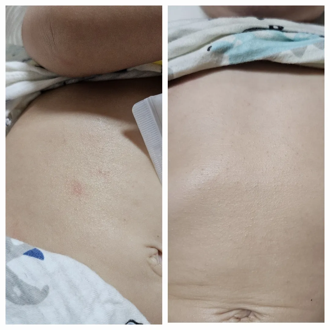 가오니 피부요 ...음식 알레르기 같기도 한데 ㅠ주말이라 갑갑하네유,,,