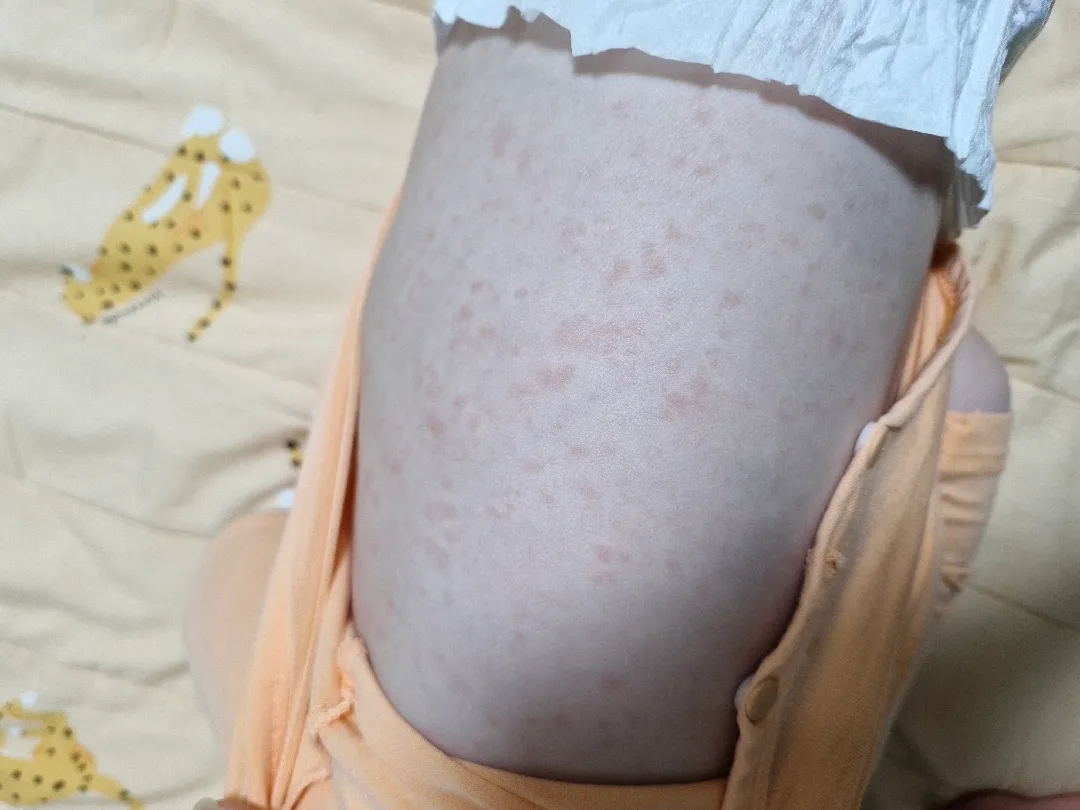 돌발진(?)일까요?