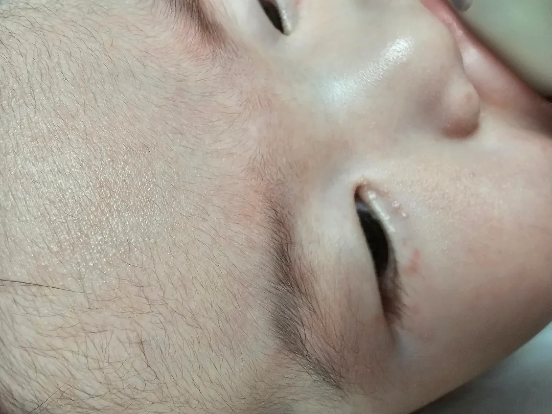 눈밑에 뭐가났어요
