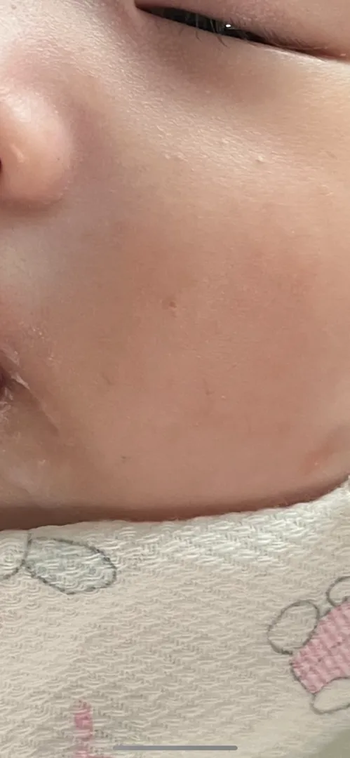 아가 피부 ㅠㅠㅠ