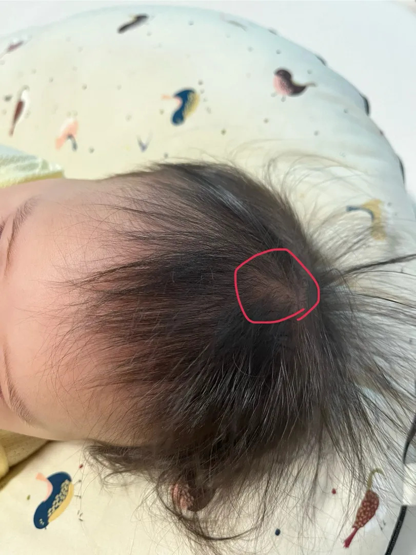 8개월 아기 대천문이 약간들어간거같아요