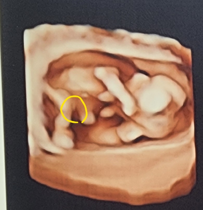 14주아기 초음파 생식기 일까요?