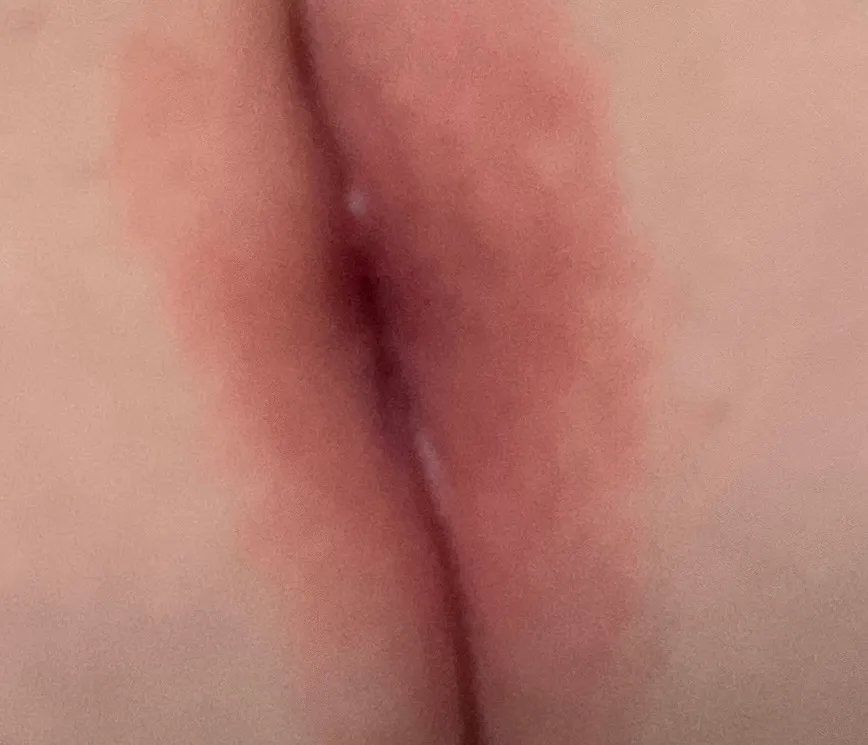 기저귀 발진 일까용...?