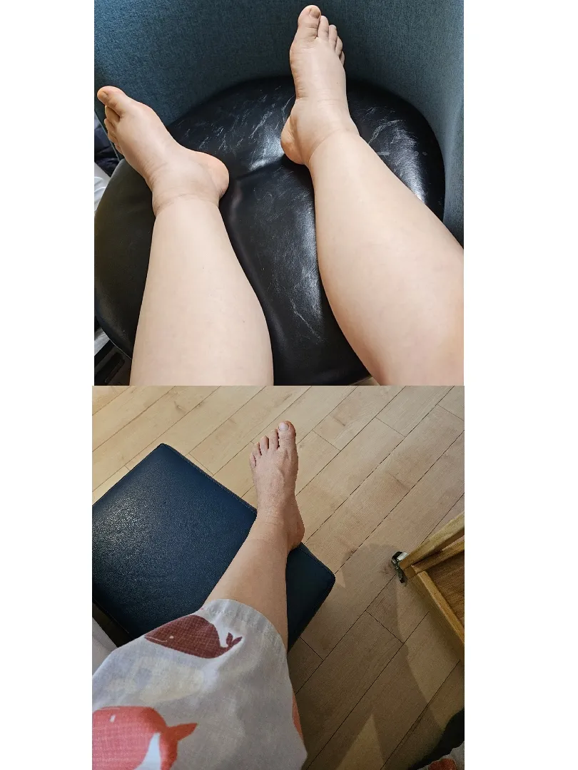 붓기