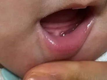 아기잇몸