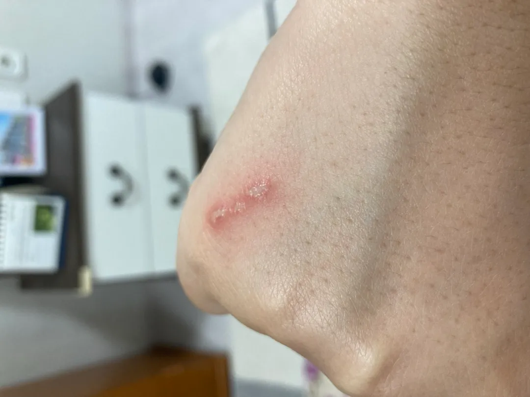 대상포진