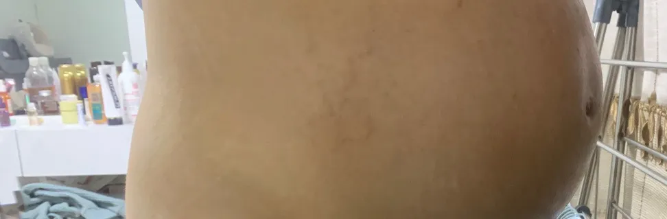 튼살 ㅠㅠㅠ