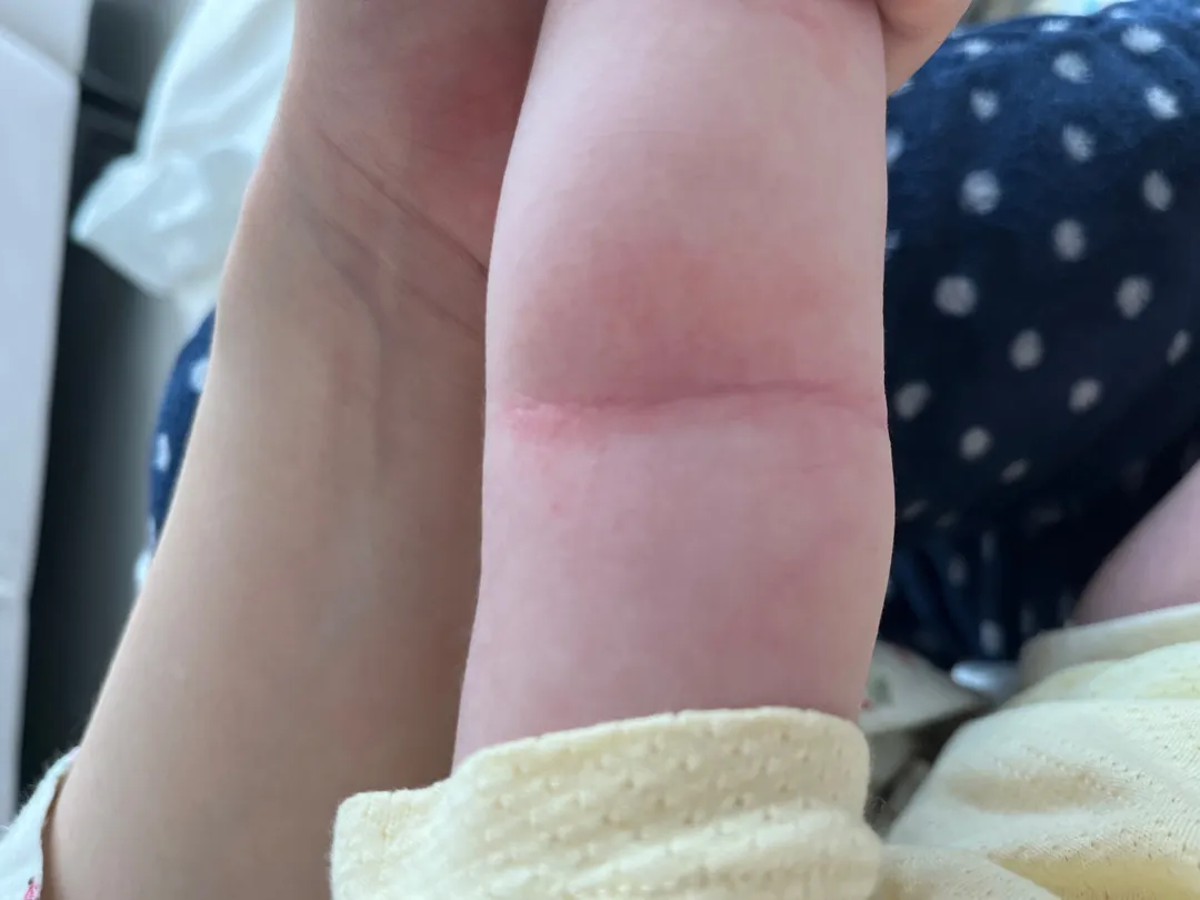 이건 땀띠일까요?