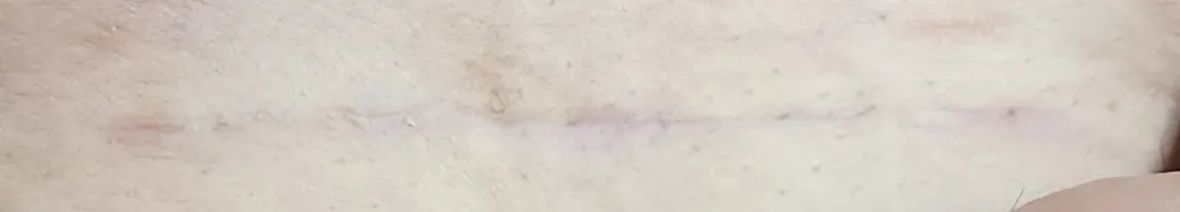 제왕 흉터 다들 이정도만 남으신건가요?