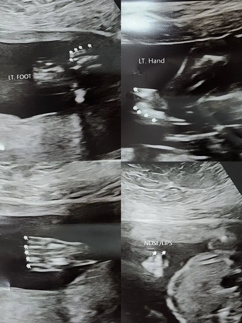 20주 2일차  저만 배아픔이나 배땡김이.없는건가요 ㅠㅠ