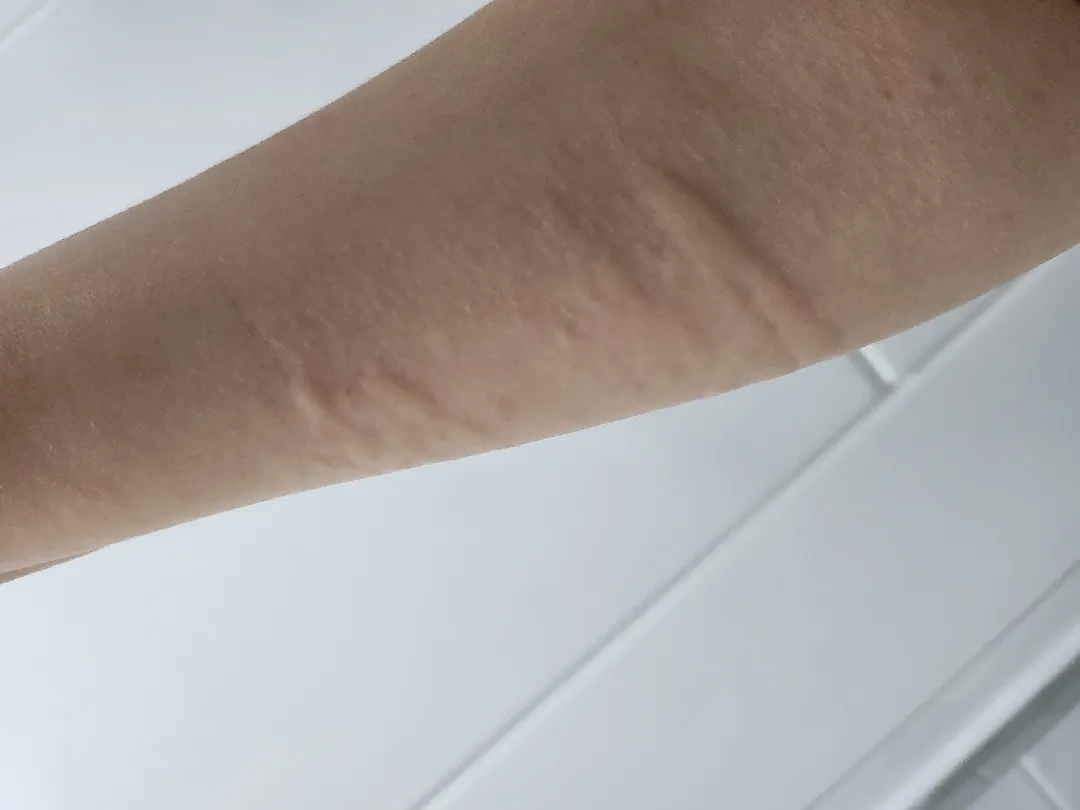 가려운증상과 두드러기..출산때문일까요? 