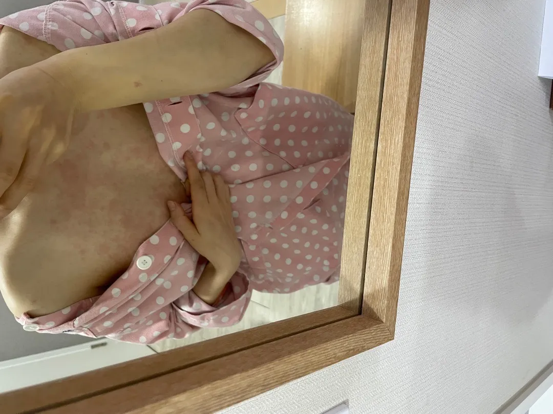 출산후 소양증