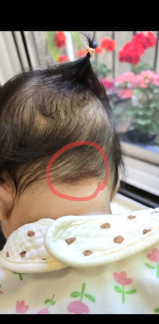 뒷머리 두피 붉은데 발진일까요?!