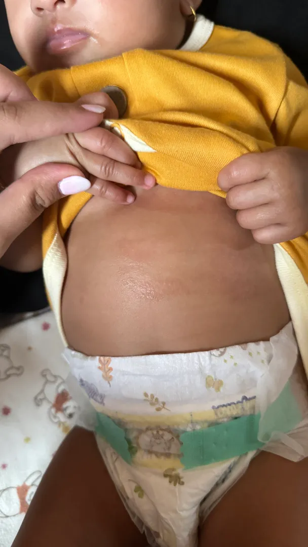 Kulit baby eksim