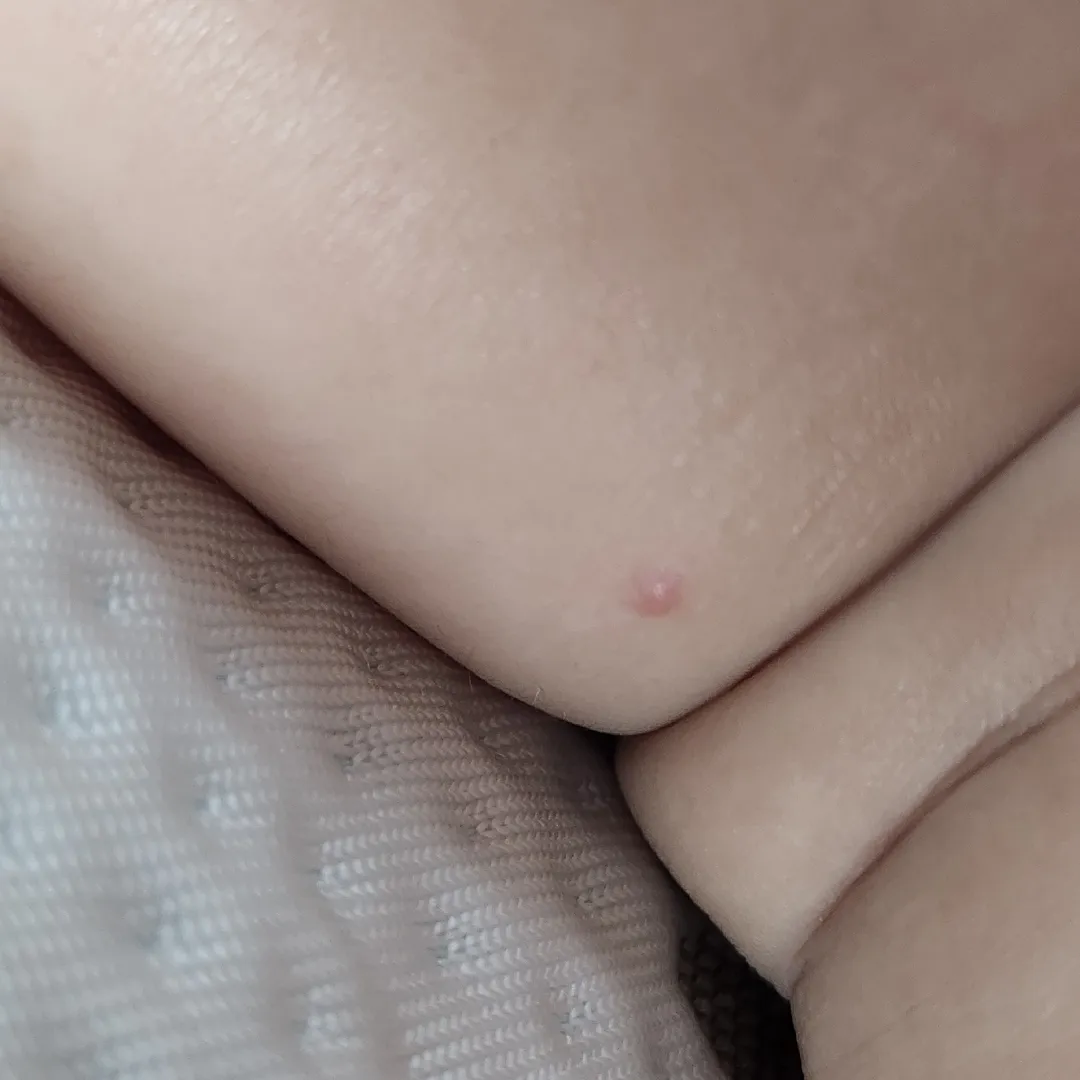 이거 수족구 일까요?