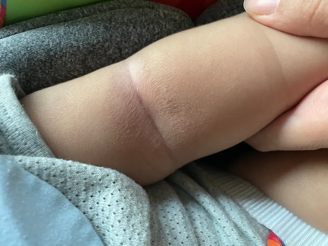 왼팔 접히는 부분이 이렇게 되었어요😭