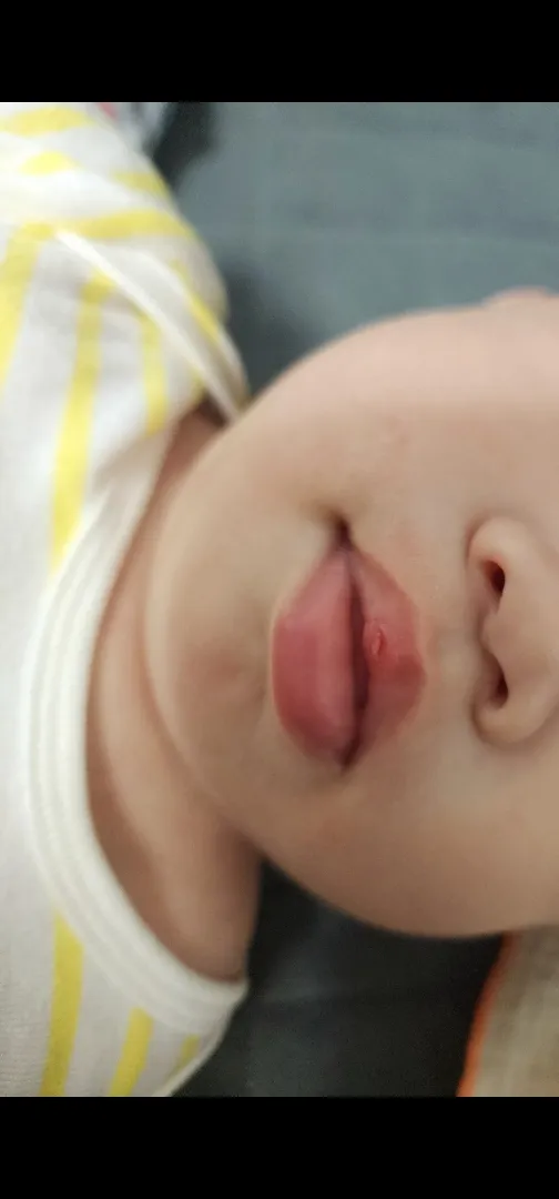 8개월아기 입술찢어짐