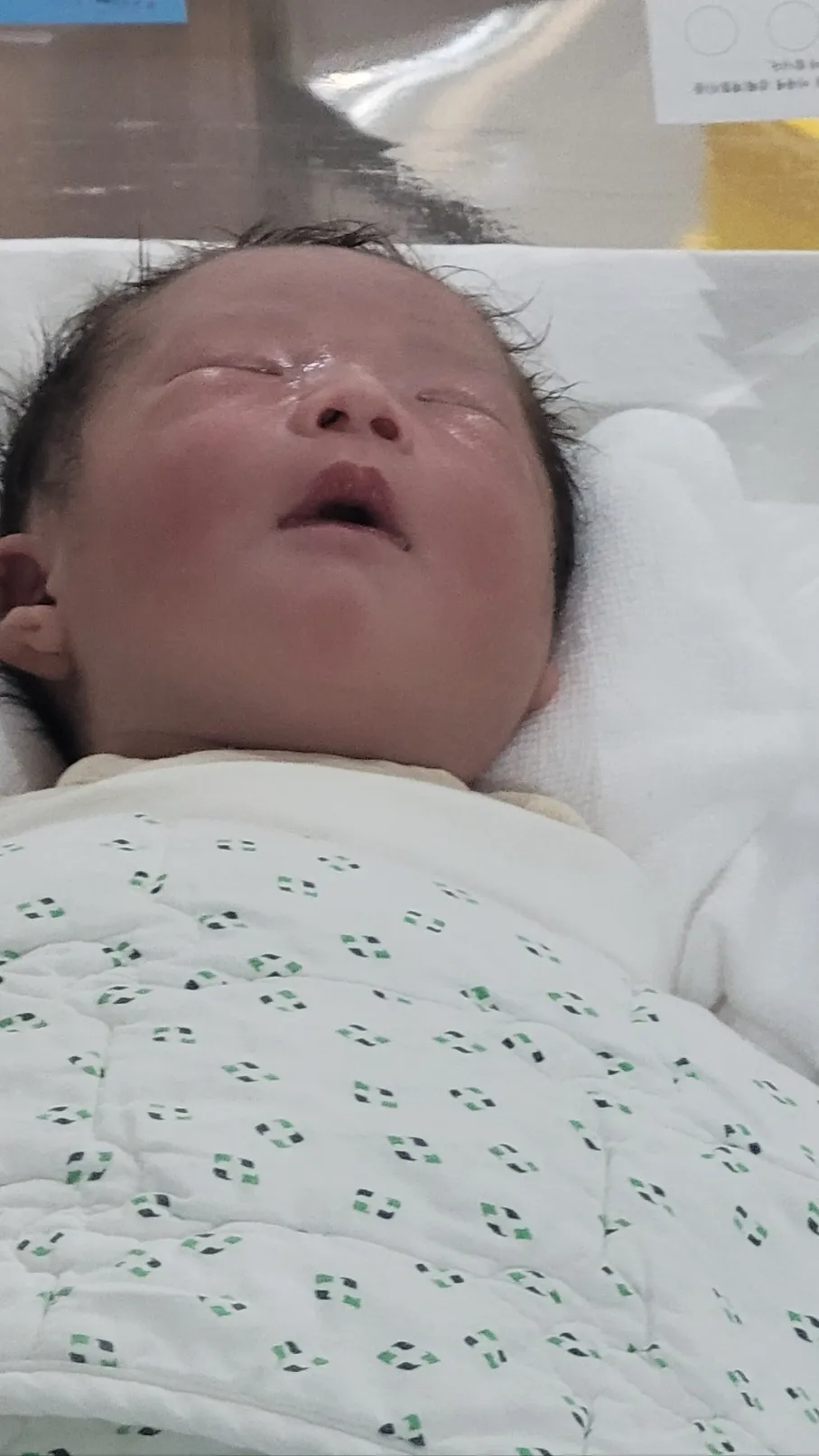 39주 3일 응급제왕