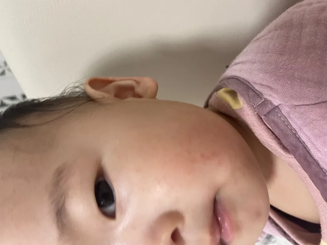 아토피일까요? ㅠㅡㅜ