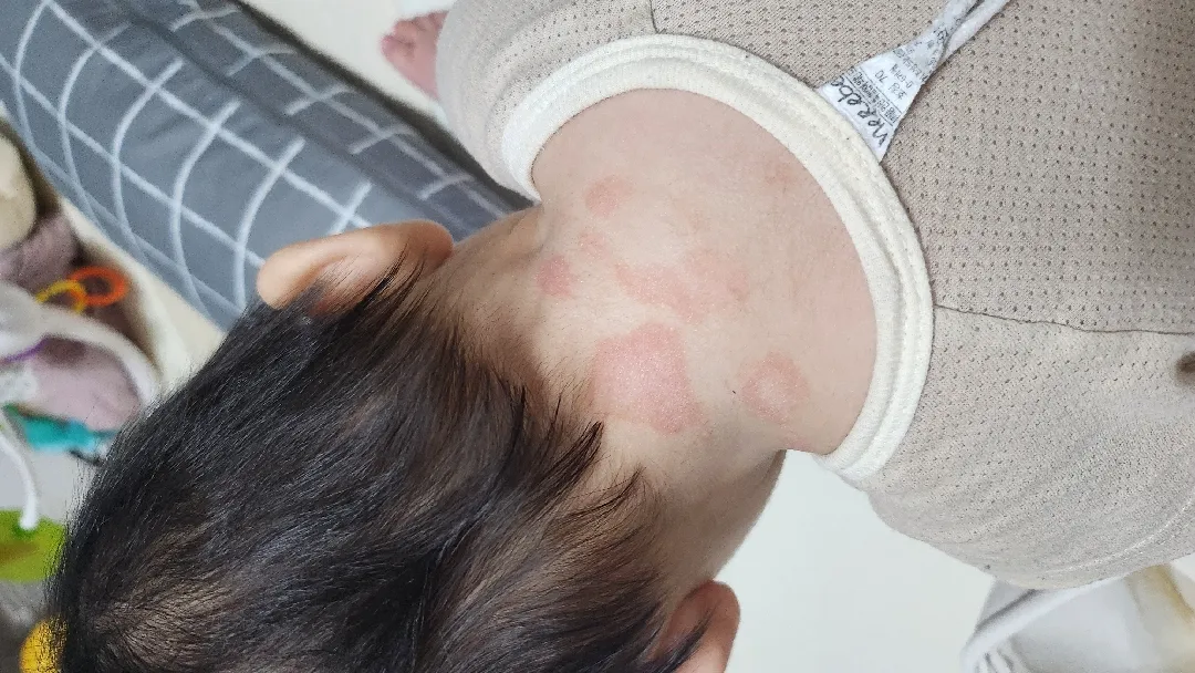 아기 땀띠?피부염? 한번 봐주세요ㅠㅠ