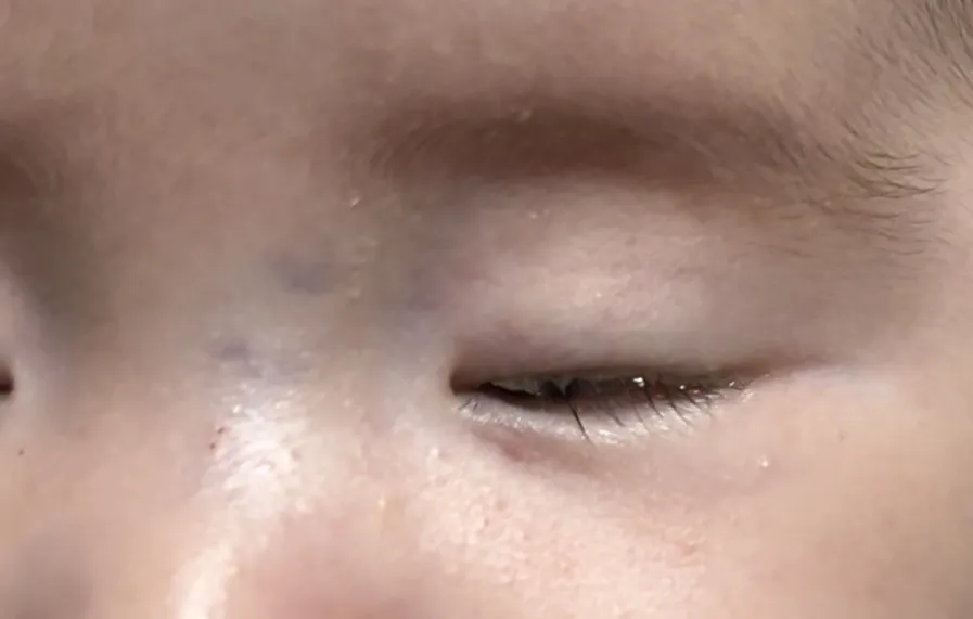 아기 눈