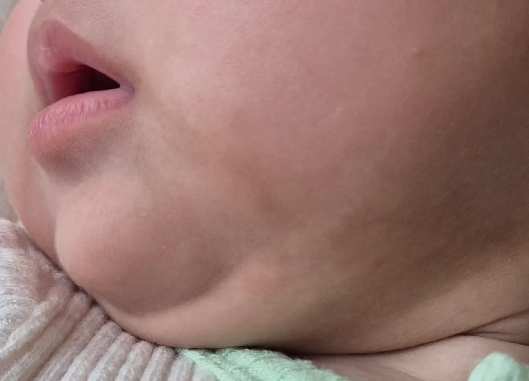 턱이 이 얼룩 점 같은게 뭘까요? 밀크 반점일까요?ㅜㅜ