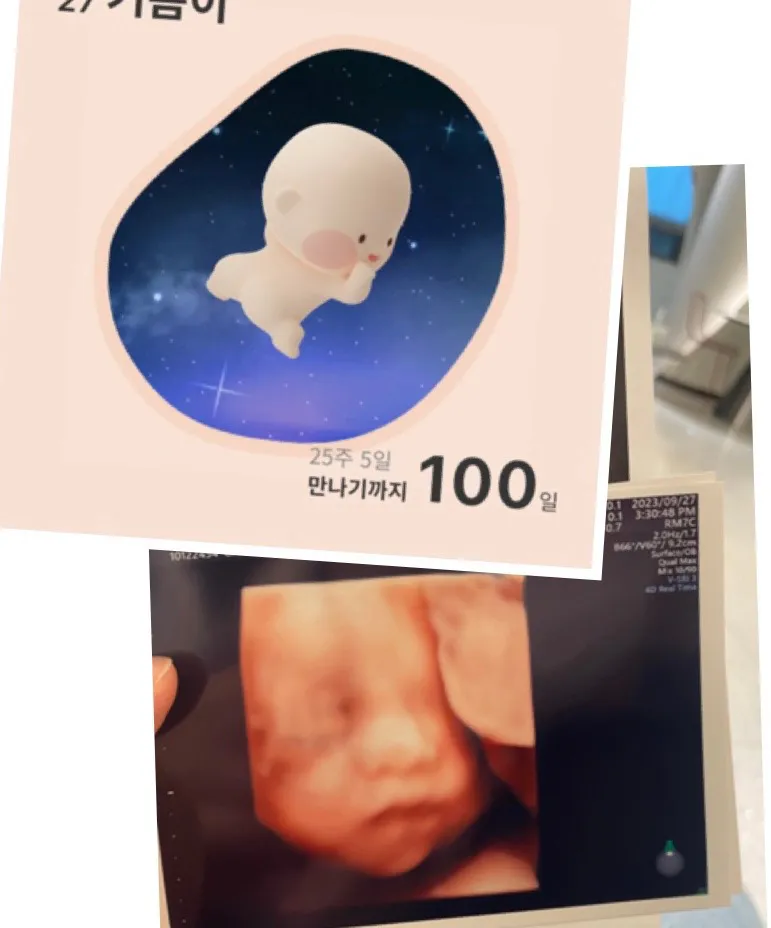 25주 5일 태아무게 1kg신분..