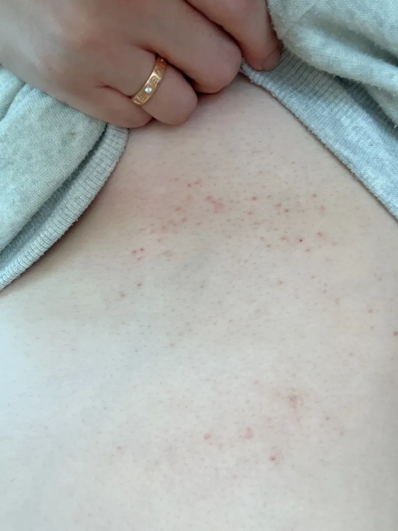 소양증 오신분들 봐주세요ㅠㅠ