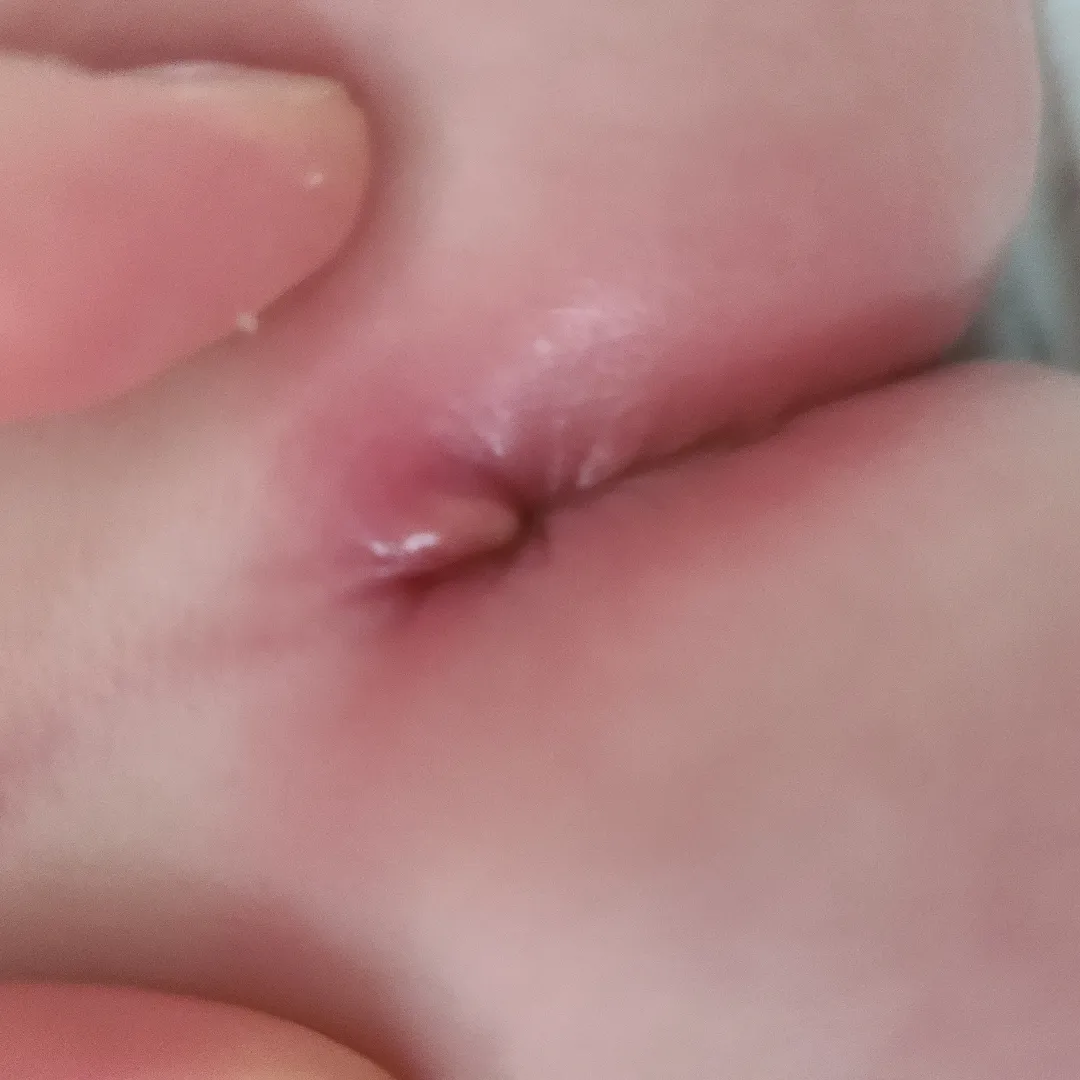 95일 남아  항문에 종기