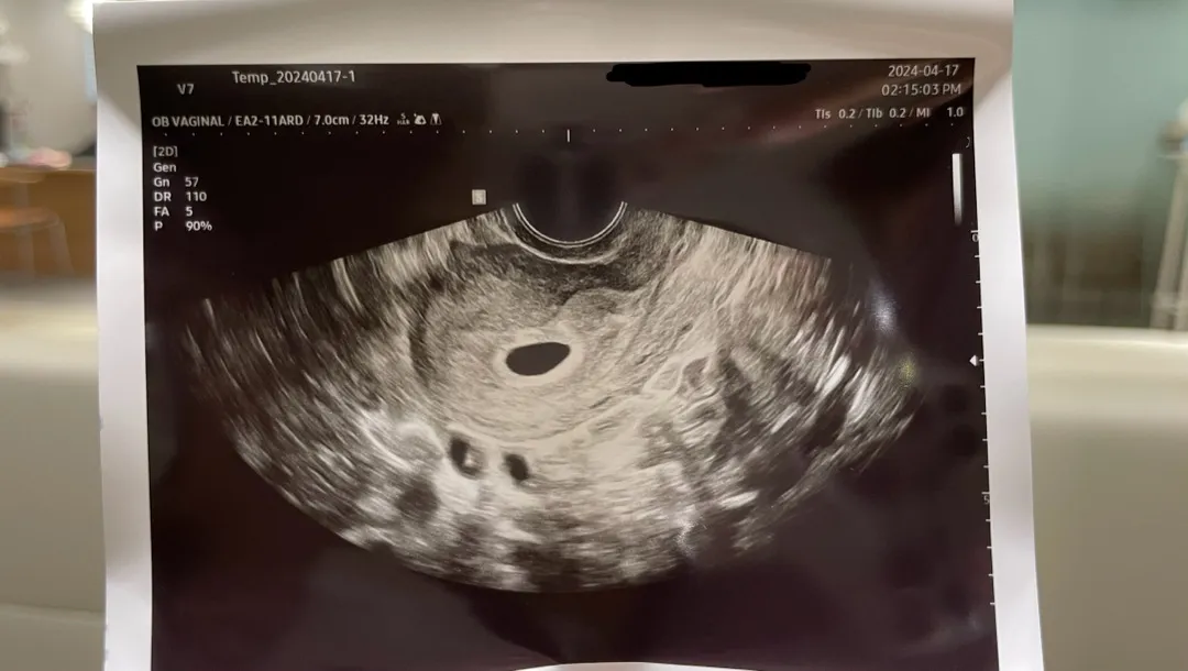 난임병원 졸업했는데 다른병원가도되겠죠?