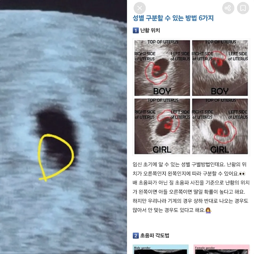 난황 위치로 보는 태아 성별?