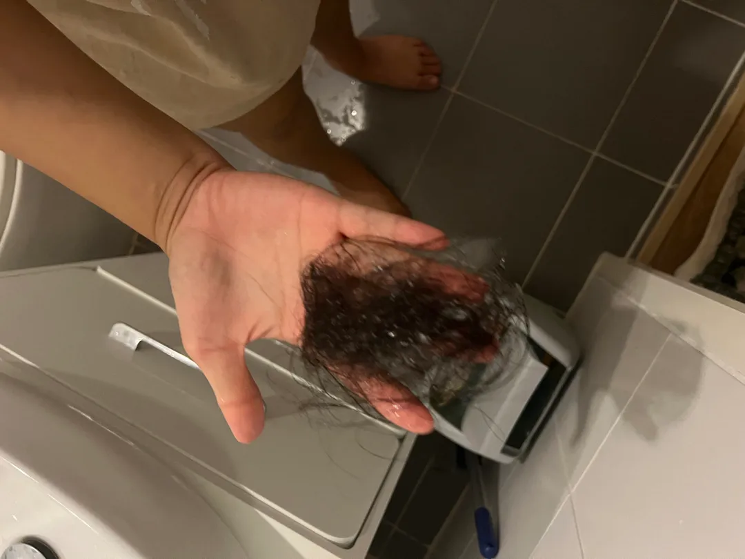 머리 이정도로 빠지시나요?