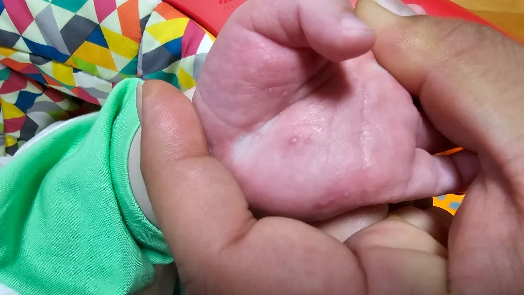 211일 남아 입니다 손이 왜이럴까요.