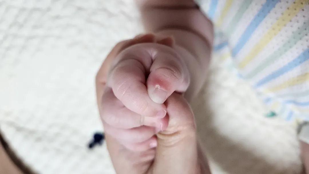 손가락이 왜이럴까요ㅠㅠ
