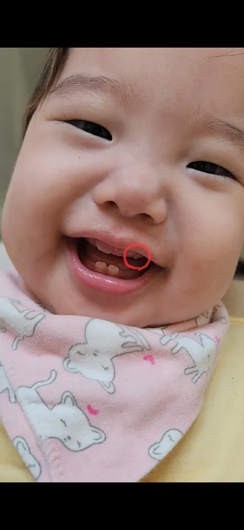 옆에 이가 먼저나기도 하나요??